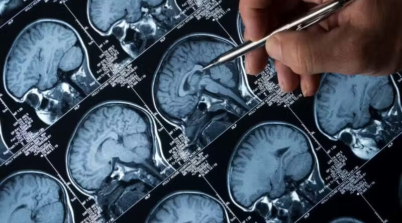 Cientistas conseguem reverter Alzheimer com terapia inovadora em camundongos